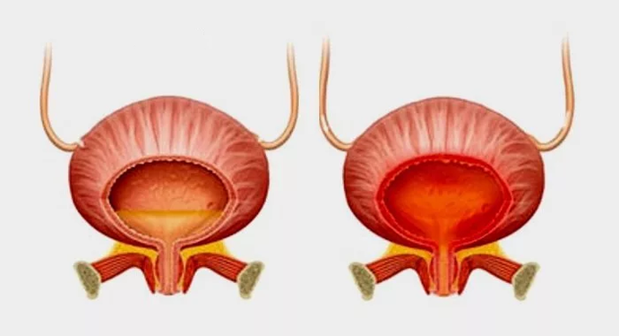 Φυσιολογική κύστη (αριστερά) και κυστίτιδα με κυστίτιδα (δεξιά)